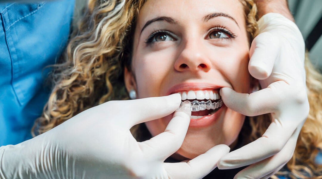 braces in invisalign