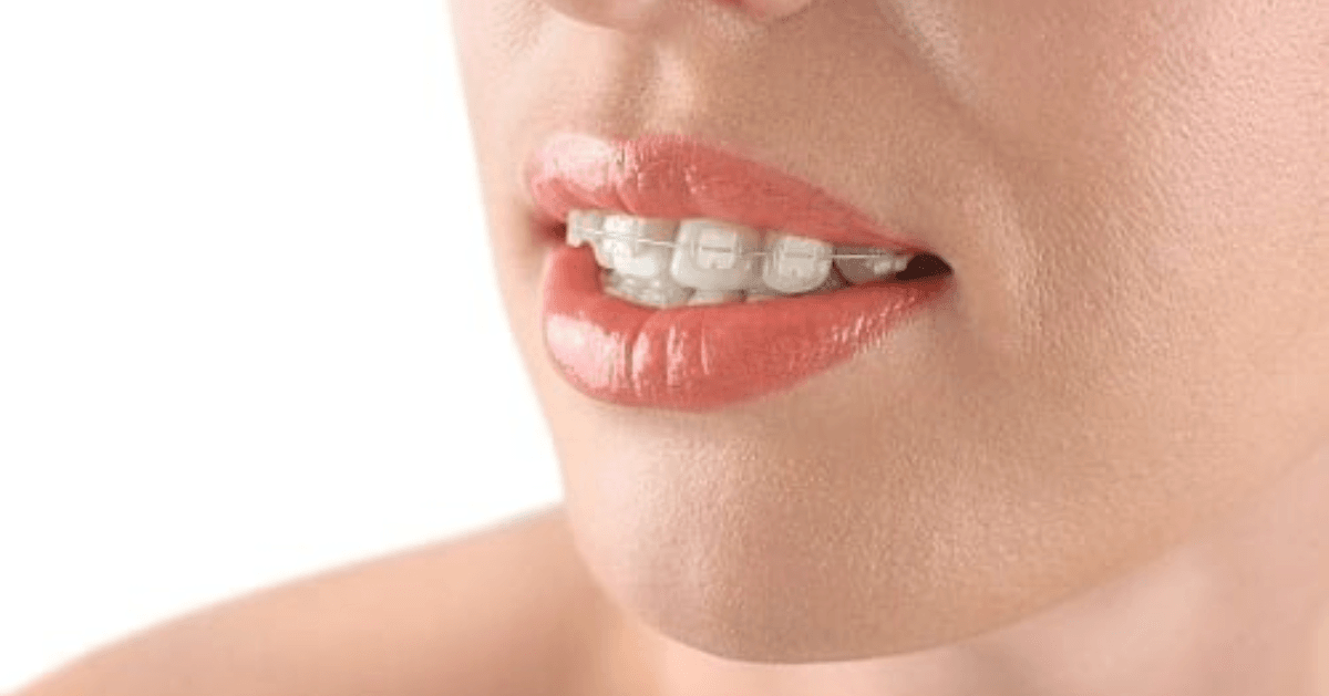 clear braces