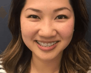 clear braces