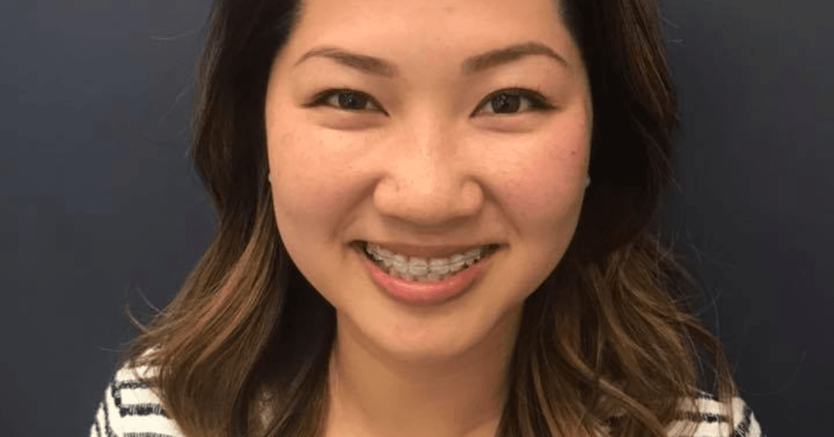 clear braces