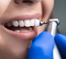 teeth whitening