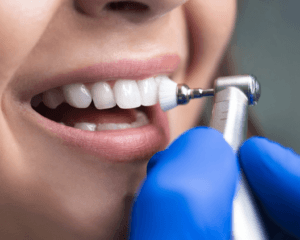 teeth whitening