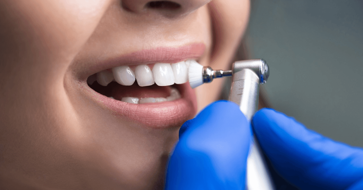 teeth whitening