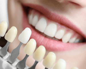 veneers