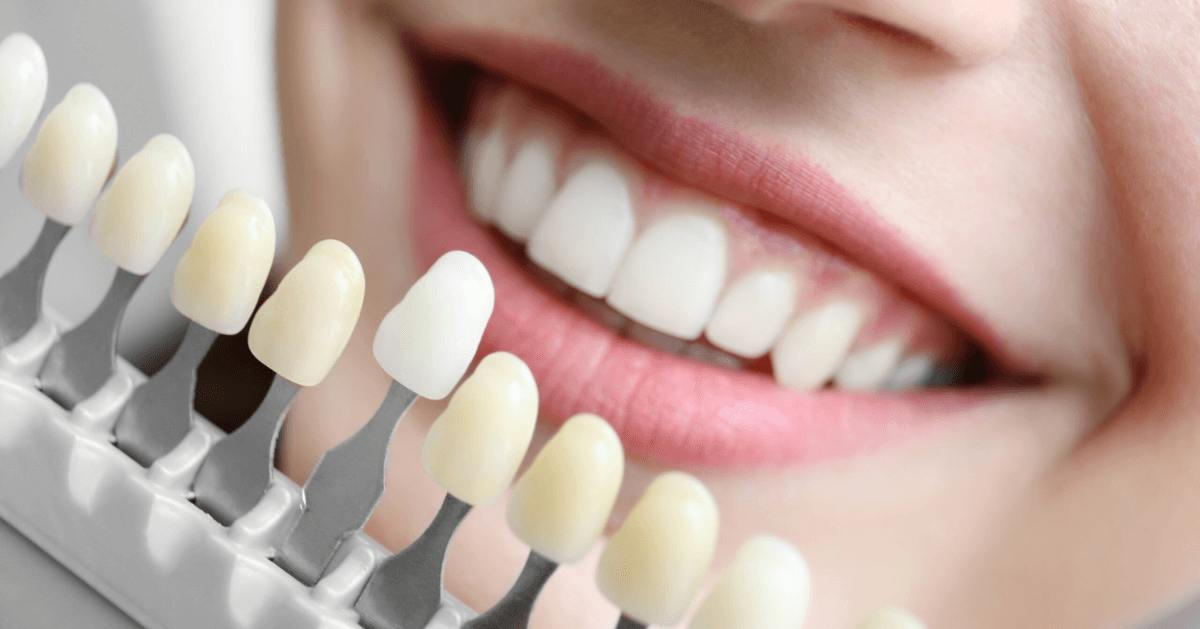 veneers