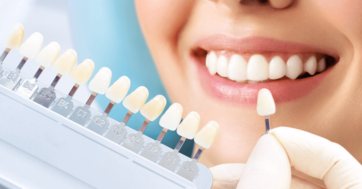 veneers