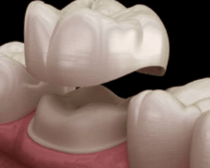 Dental Crowns