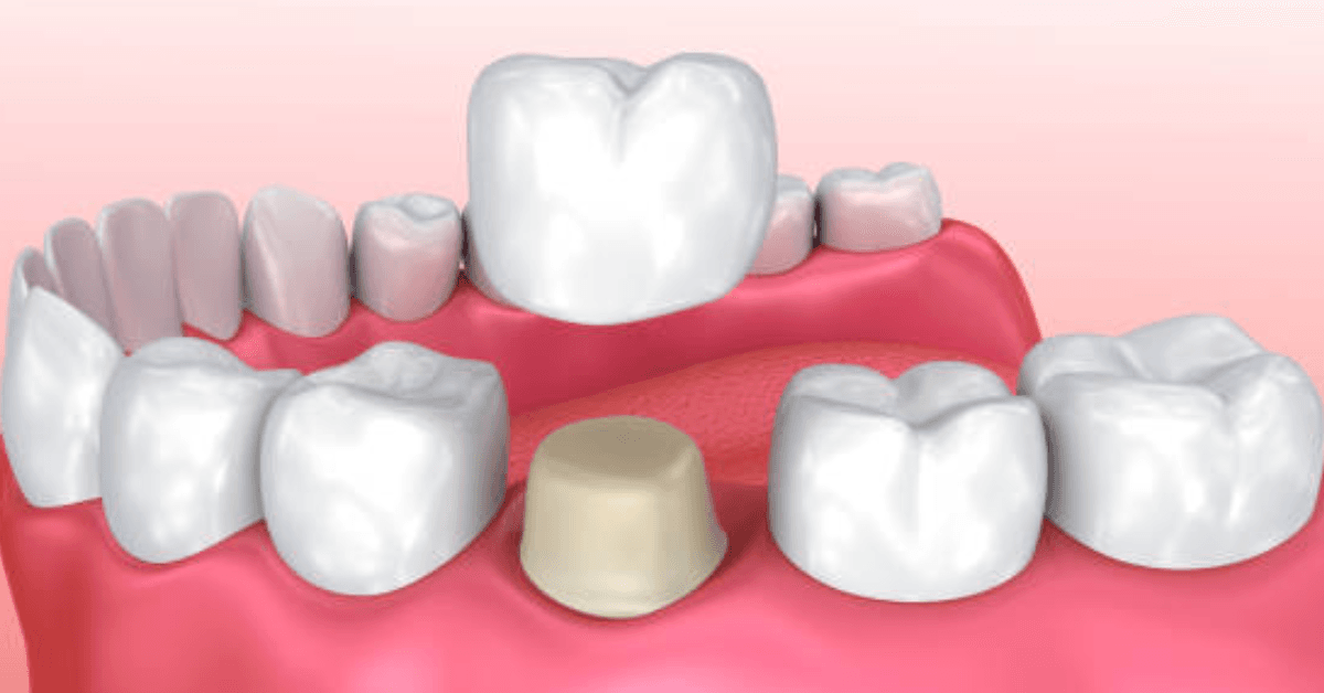 Dental Crowns Near Me