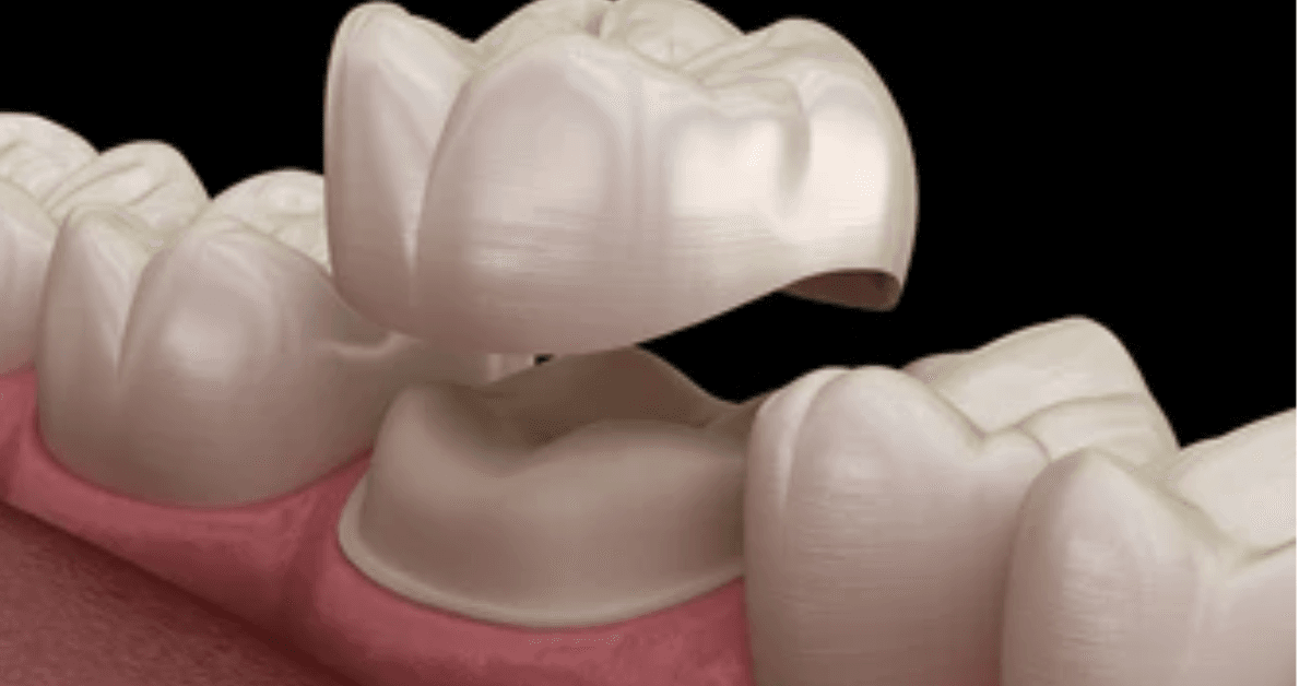 Dental Crowns