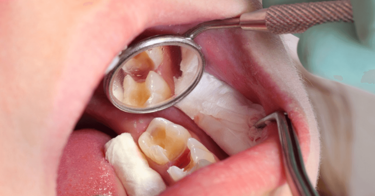 Tooth-Colored Filling Services