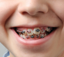 braces