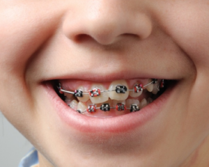braces