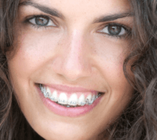 braces near me