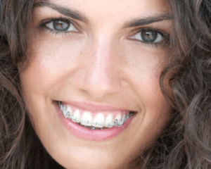 braces near me