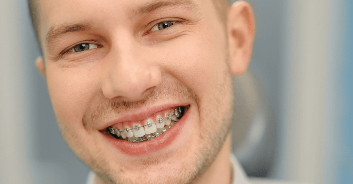 braces