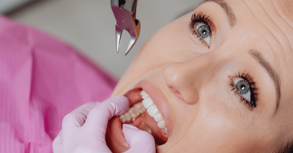 dental extraction