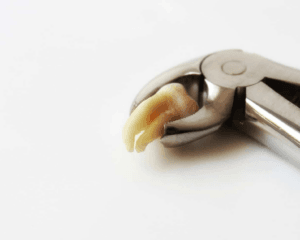 dental extractions