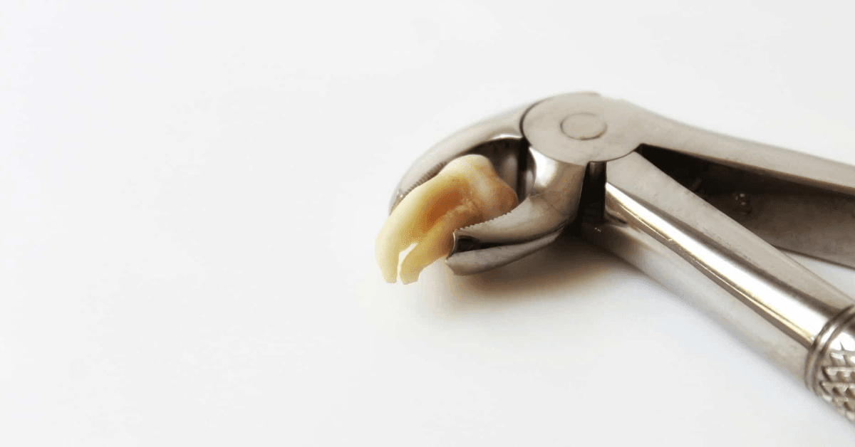 dental extractions