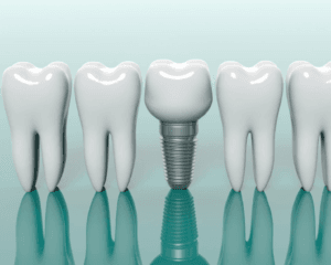 dental implants near me