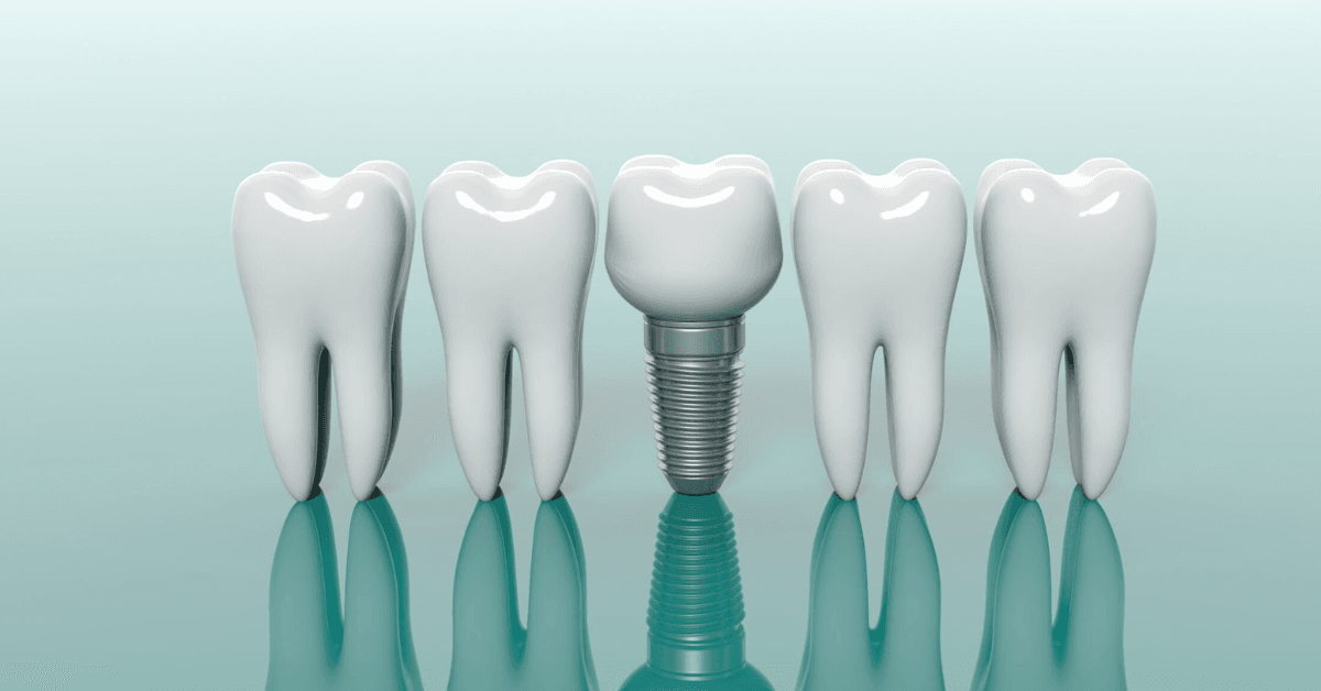 dental implants near me