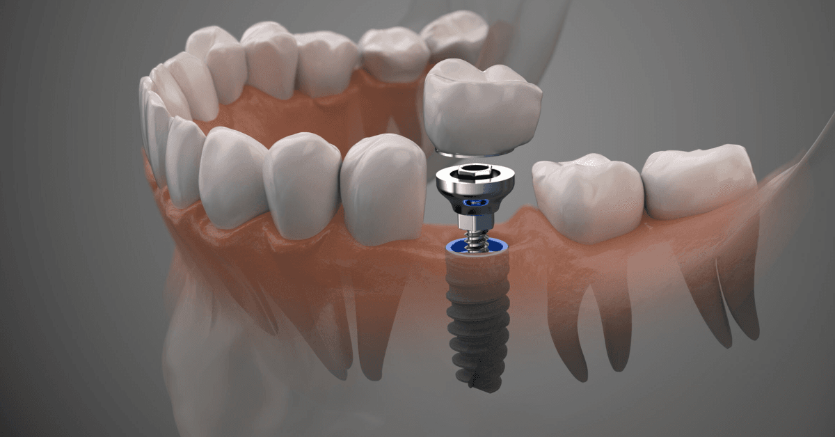 dental implants