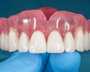 denture repair services