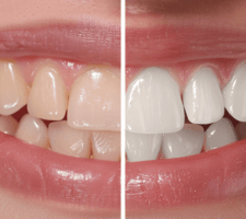 teeth whitening las vegas