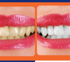 teeth whitening las vegas