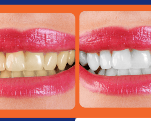 teeth whitening las vegas