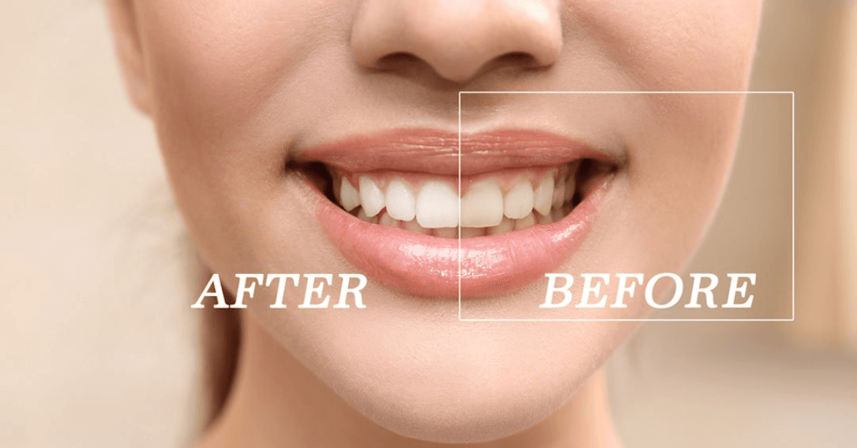 teeth whitening las vegas nv