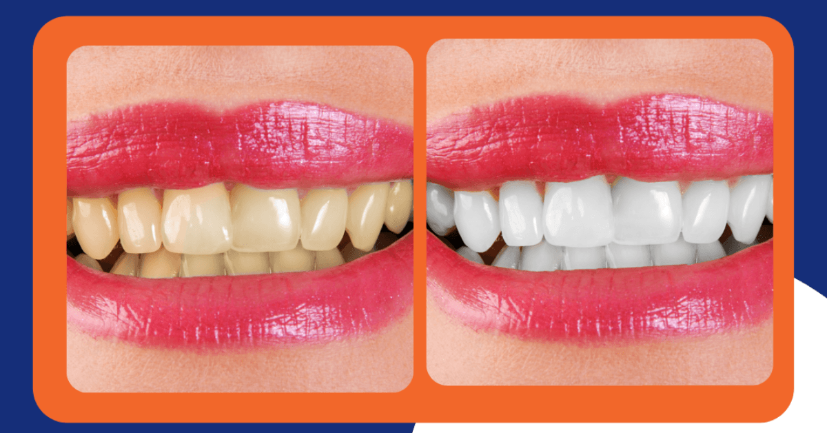 teeth whitening las vegas