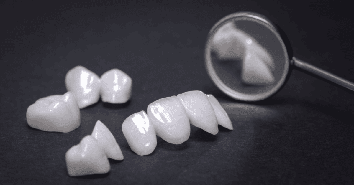 tooth veneer services