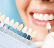 veneer services
