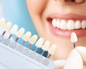 veneer services