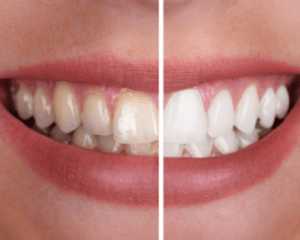 Teeth Whitening