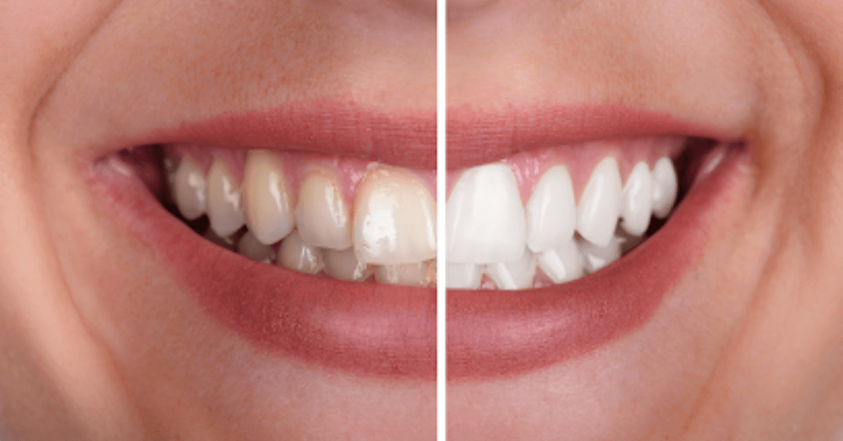 Teeth Whitening