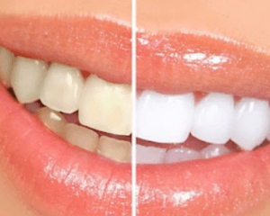teeth whitening