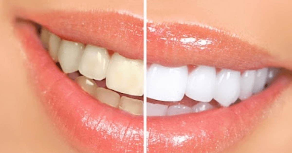 teeth whitening