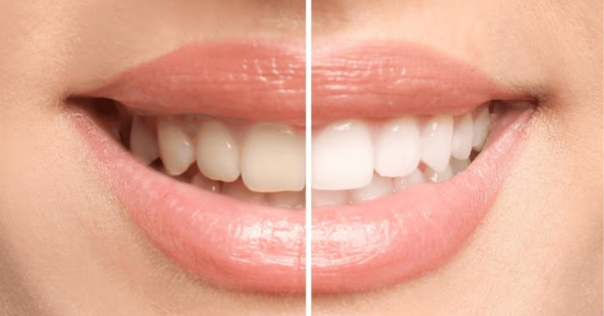 teeth whitening services