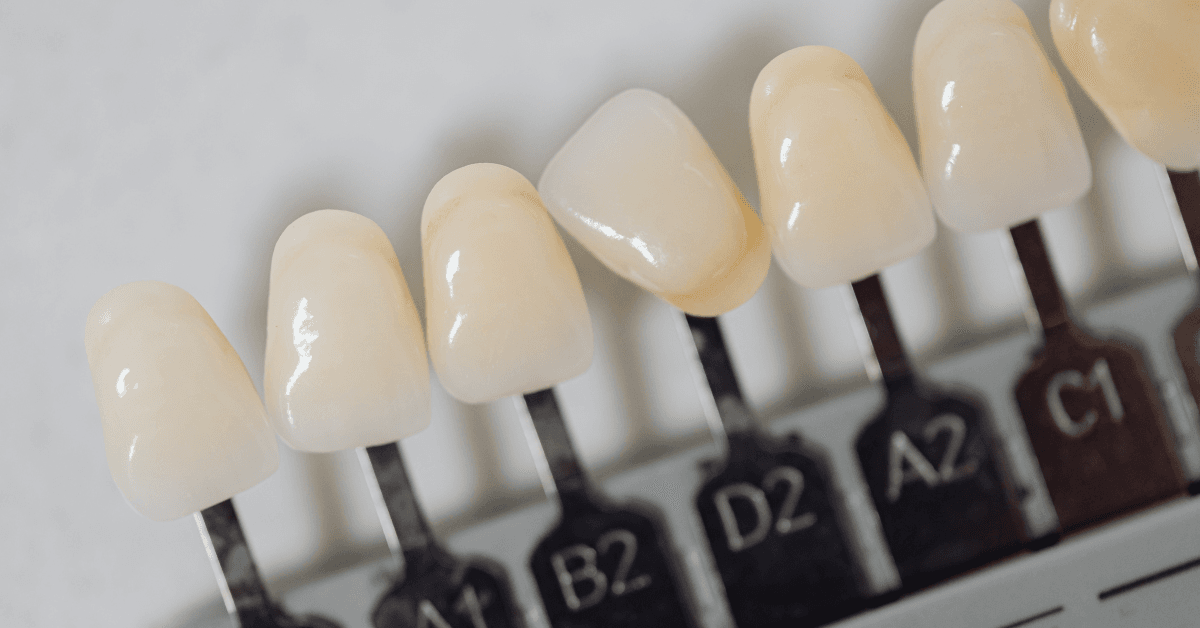 veneers