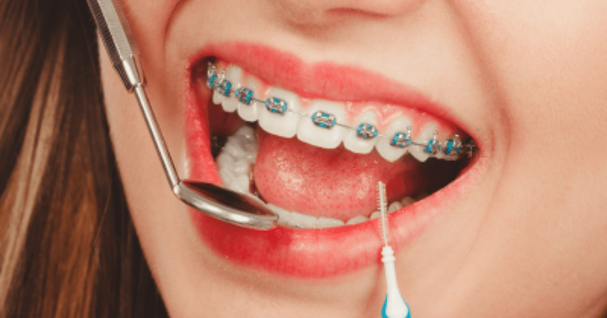 Braces