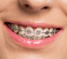 braces near me