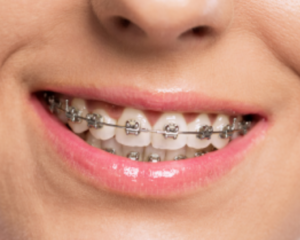 braces near me