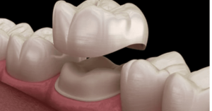 No More Hiding Your Smile! Boca Dental’s Dental Crowns Make Damaged Teeth Look Brand New