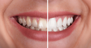 Smiling from Within: The Holistic Benefits of Teeth Whitening on Self-Esteem