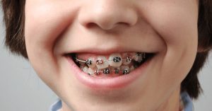 Braces vs. Misalignment: How Boca Dental and Braces Wins the Battle for Your Perfect Smile