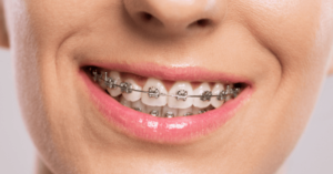 How Braces in Las Vegas Improve Airway Function While Fixing Crowding