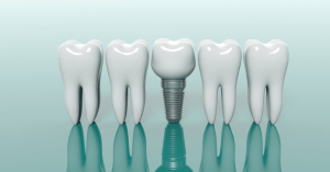 Afraid of Dental Implants? Boca Dental & Braces Makes the Process Effortless