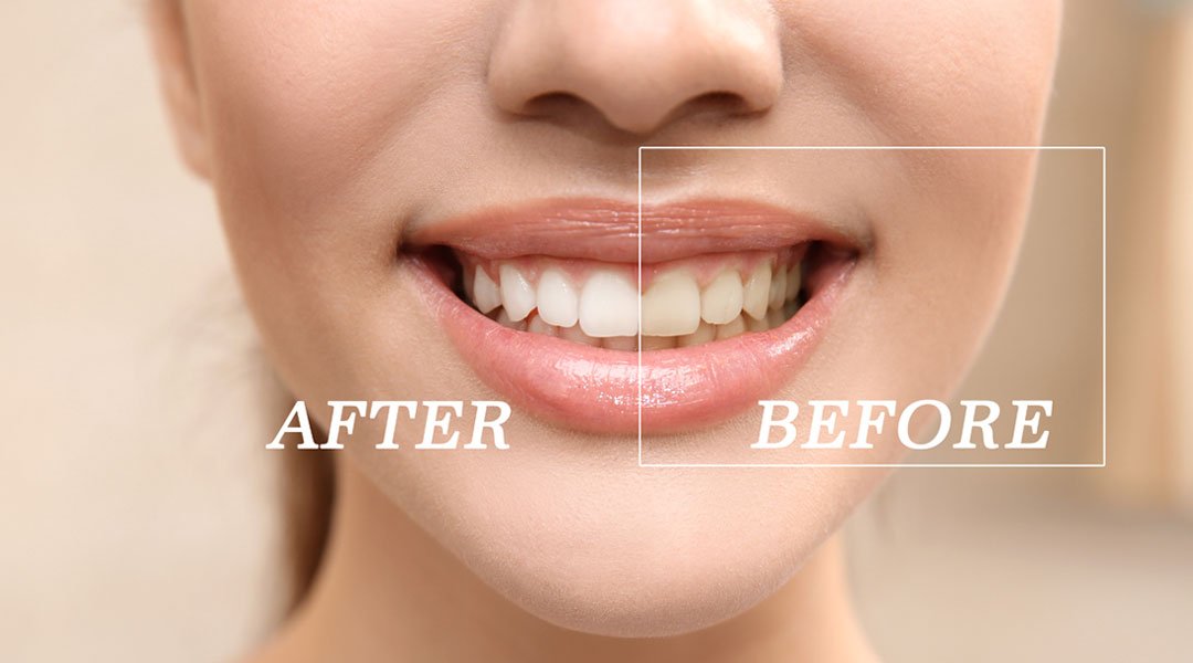 Cosmetic Teeth Whitening Las Vegas NV