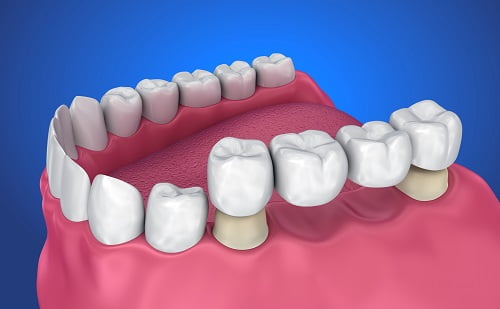 Dental Crowns & Bridges in Las Vegas, NV